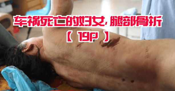 车祸死亡的妇女，腿部骨折【19P】