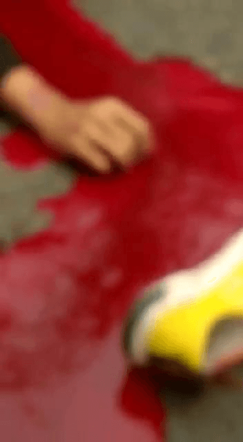 直接脑死亡